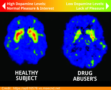 dopamine levels in a person's brain is one of the risk factors for addiction