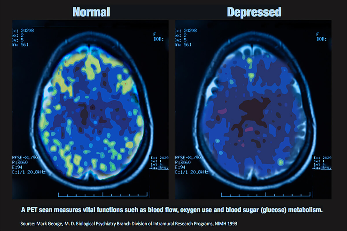 the comparing pictures between normal brain and depressed brain.